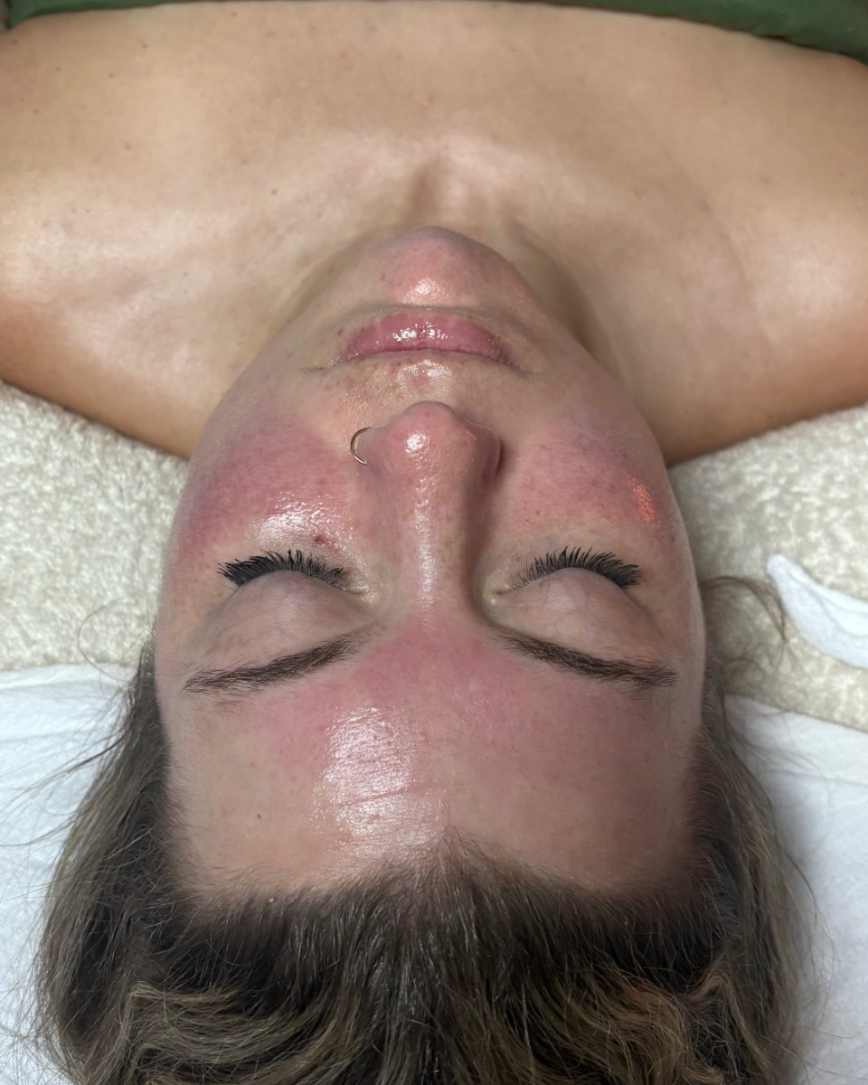 Jessner peel application