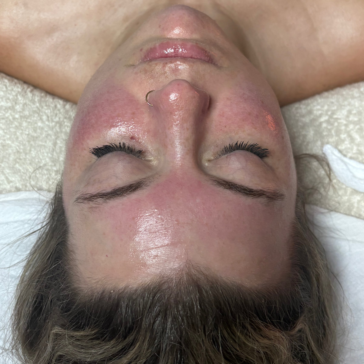 Chemical Peel treatment