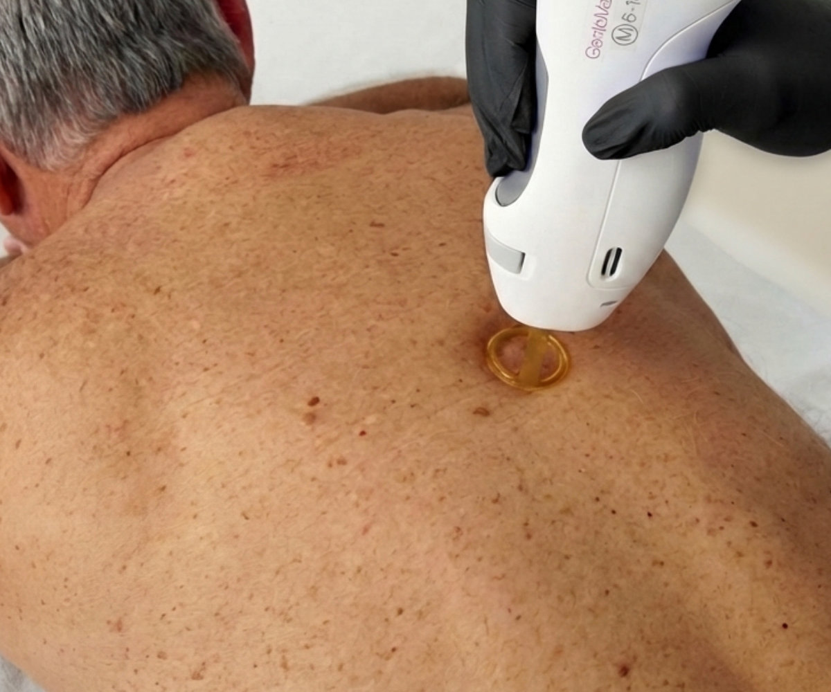 Large area laser hair removal treatment